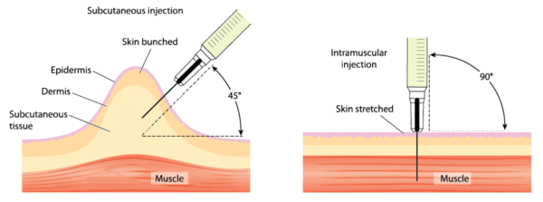 How To Give Yourself An Intramuscular Injection - Iv Me Now Fl